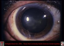 Corneal Laceration