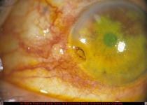 Embedded Corneal Metallic Foreign Body