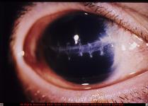 Corneal Laceration