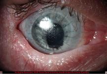 Corneal Scarring and Extensive Symblepharon Due to Alkali Burn