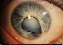 Corneal Laceration