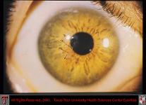 Corneal Laceration