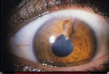 Corneal Laceration