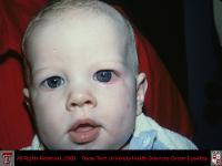 Buphthalmos Due to Congenital Glaucoma