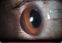 Severe Corneal Ectasia and Aphakia in Keratoconus