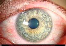 Corneal Transplant with Running Suture