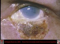 Thermal Burn to Cornea and Lower Lid