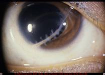 Corneal Laceration