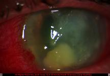 Severe Pseudomonas Keratitis