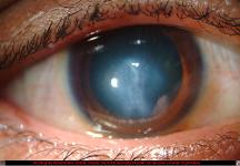 Acute Hydrops in Keratoconus