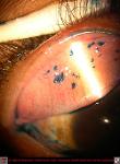 Filamentary Keratitis with Palpebral Conjunctival Filaments