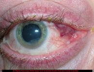 Exposure Keratopathy and Dilated Conjunctival Vein Due to Thyroid Eye Disease