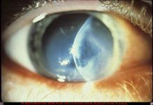 Acute Hydrops in Keratoconus