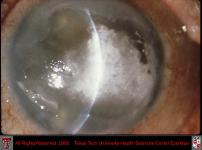 Calcium Deposit in Cornea Secondary to Timolol Plus Pred Phosphate