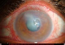 Acanthamoeba Keratitis