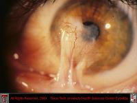 Symblepharon and Corneal Scarring Due to Battery Acid Burn