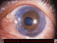 Cogans Interstitial Keratitis