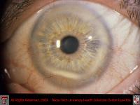 Rosacea Blepharoconjunctivitis with Corneal Scarring and Neovascularization