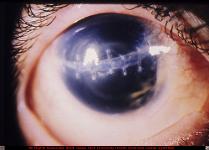 Corneal Laceration