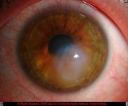 Acute Hydrops in Keratoconus