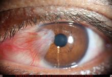 Nasal Pterygium