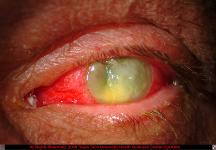 Severe Pseudomonas Keratitis