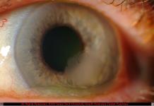 Focal Limbal Stem Cell Deficiency