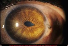 Corneal Laceration