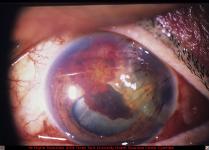 Corneal Laceration