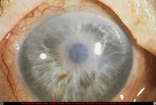 Corneal Edema Due to Descemet's Membrane Detachment