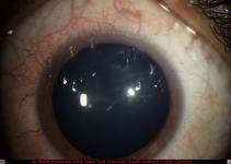 Filamentary Keratitis