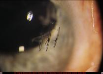 Corneal Laceration