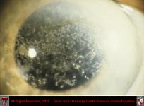 Infections Crystalline Keratopathy