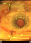 Corneal Scarring and Extensive Symblepharon Due to Alkali Burn