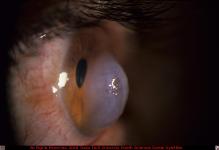 Acute Hydrops in Keratoconus