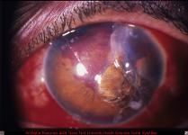 Corneal Laceration