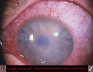 Bullous Keratopathy