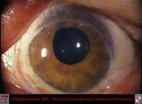 Thermal Corneal Burn After Penetrating Keratoplasty