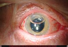 Descemet's Stripping Automated Endothelial Keratoplasty Postoperative Day One