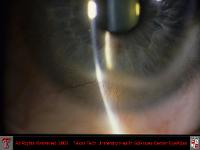Rosacea Blepharoconjunctivitis with Corneal Scarring and Neovascularization