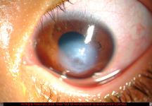 Acute Hydrops in Keratoconus