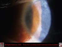 Cogans Interstitial Keratitis