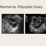 Normal vs Polycystic Ovary
