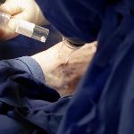 Dr. Alan Pang performs the laser treatment on Tonya Lambert's burn scars