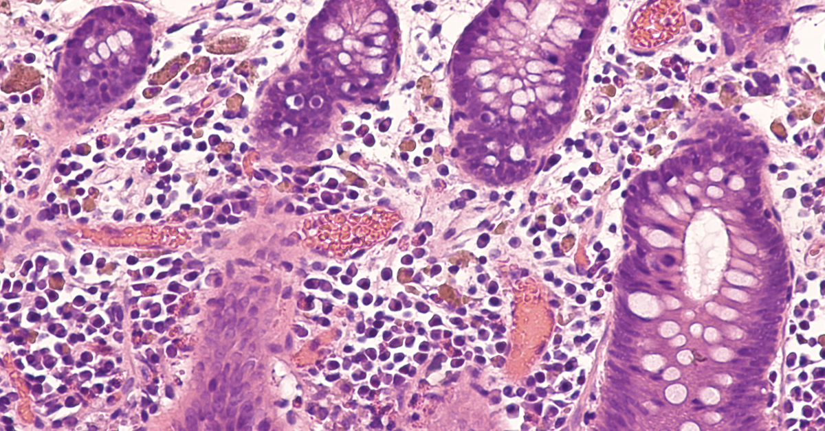 microscope view of colon cancer cells