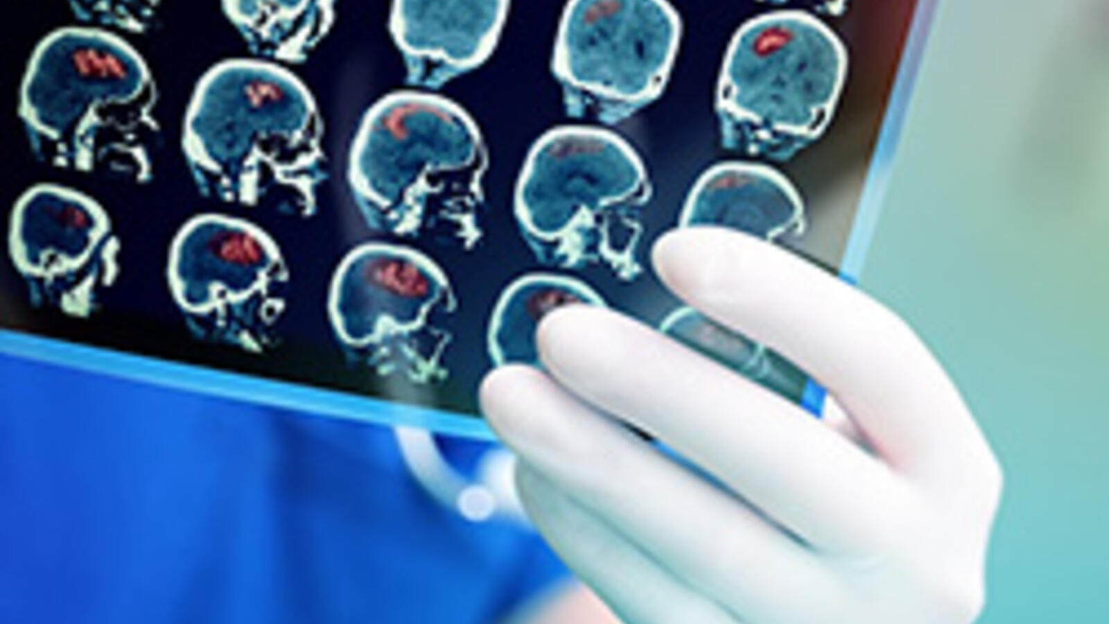 Stroke Image
