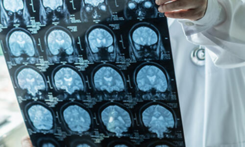 Medical professional examining a series of brain MRI scans displayed on a radiology film.