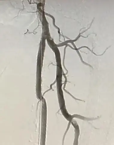 Arteries during PAD procedure