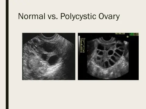 Polycystic Ovary Syndrome