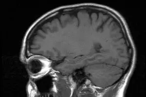 This trial is expected to build upon previous success to bring an approved treatment for traumatic brain injuries to the market.